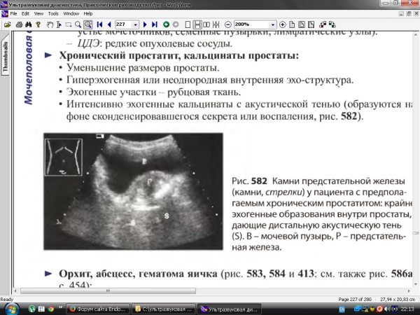 Хронический простатит узи картина